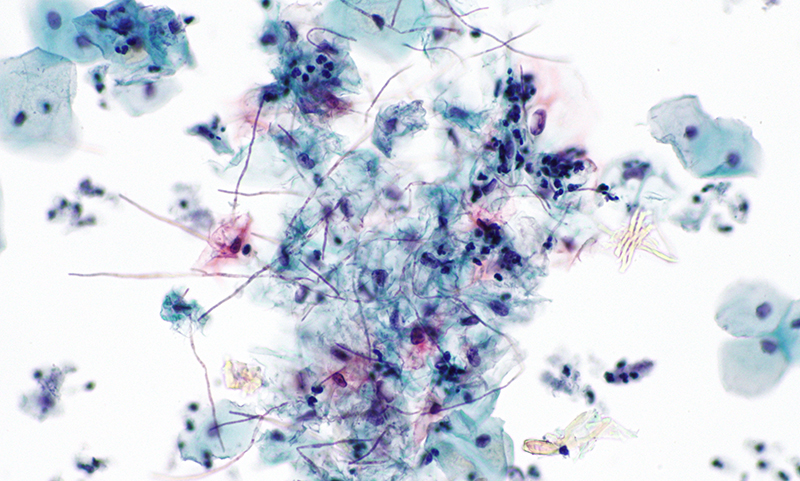 Abnormal cells under a magnifying glass
